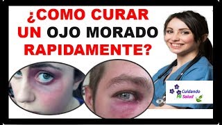 💡 COMO CURAR UN OJO MORADO  3 pasos para tratar y eliminar Moretones o Hematoma facial 2021 ✅ [upl. by Hanna269]