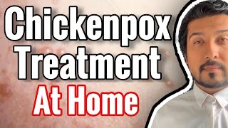 Chickenpox Treatment At Home 2020 [upl. by Llerrac]