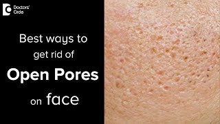 What are open pores and treatment options for that  Dr Vignesh Raj [upl. by Ariamo755]