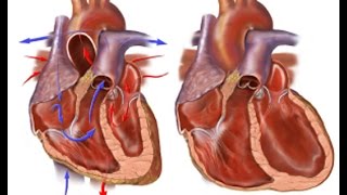 Congestive Heart Failure [upl. by Bennion]