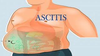 ASCITIS FISIOPATOLOGÍA TIPOS DIAGNÓSTICO TRATAMIENTO SÍNDROME ASCÍTICO [upl. by Rialb]