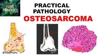 OSTEOSARCOMA Clinical  Radiological features amp Morphology [upl. by Enela797]