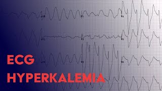 Hyperkalemia EKG Findings  ECG Interpretation [upl. by Oinota]