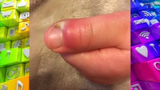 How to Spot an Infection around the Nail [upl. by Roinuj164]