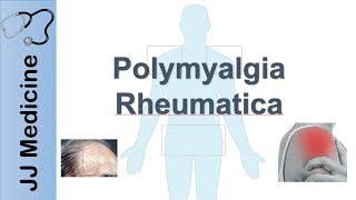 Polymyalgia Rheumatica  Signs amp Symptoms Diagnosis and Treatment [upl. by Onairpic]