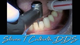 Prepping Teeth for Lower Veneers  Dental Minute with Steven T Cutbirth DDS [upl. by Allimak]