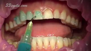 Prepless Veneers Permanent Teeth Whitening [upl. by Ayeki507]