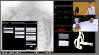 Aortic Arch Angiogram [upl. by Kooima]