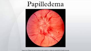 Papilledema [upl. by Suh]