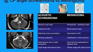 CP Angle tumors Schwannoma Meningioma [upl. by Odeen]