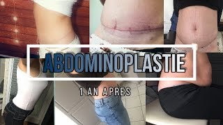 ABDOMINOPLASTIE 1 AN APRES [upl. by Layap]