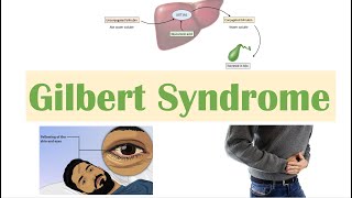 Gilbert Syndrome  Causes Genetics Pathogenesis Signs amp Symptoms Diagnosis Treatment [upl. by Ahseik]