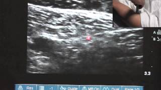 Great Saphenous Vein Ablation  For Patients [upl. by Luahs874]