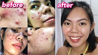 HOW I CLEARED MY ACNE  Cystic Hormonal Acne with PCOS Philippines [upl. by Killen]