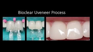 Direct Composite Veneers using the Bioclear Uveneer Process [upl. by Lear]