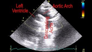 Understanding Abdominal Aortic Aneurysms  Access Health [upl. by Ahsasal]