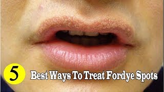 5 Best Ways to Remove Fordyce Spots Naturally at Home YouTube [upl. by Llehcear]