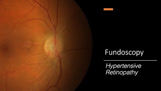 Hypertensive Retinopathy Fundoscopy [upl. by Folberth684]