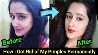 How to Remove Pimples Acne Pimple Marks completely  ThatGlamGirl [upl. by Llerref]