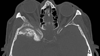 Sphenoid Wing Meningioma [upl. by Annim]