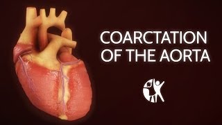 Echocardiographic assessment of bicuspid aortic valve [upl. by Accem]