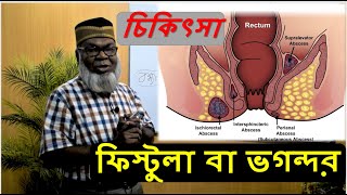 ফিস্টুলা বা ভগন্দর এর চিকিৎসা  Fistula Treatment in Bangla  Dr S Ali [upl. by Annaillil]