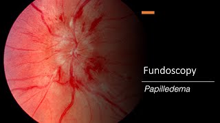 Papilledema Fundoscopy [upl. by Rafi]