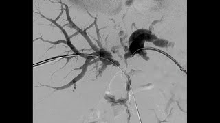 Percutaneous Transhepatic Cholangiography and Drainage PTCD [upl. by Birck155]