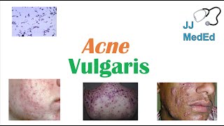 Acne Vulgaris  Causes Pathogenesis Influencing Factors Diagnosis Treatment and Complications [upl. by Murat708]