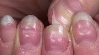 7 Health Warnings Your Fingernails May Be Sending [upl. by Willi]