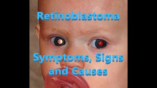 Retinoblastoma  Symptoms Signs and Causes [upl. by Nohsyt]