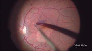 Macular Hole Surgery [upl. by Snapp]