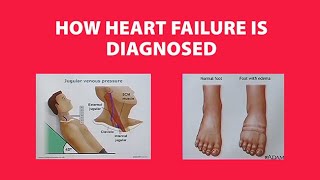 How Heart Failure is Diagnosed [upl. by Regdirb]