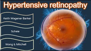 Hypertensive retinopathy simplified [upl. by Nnaylloh195]