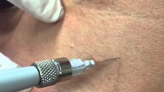 Treating angiomas amp DPNs on the chest with electrocautery For medical education NSFE [upl. by Theodore]