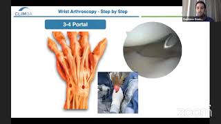 Wrist Arthroscopy Step by Step [upl. by Lyrahc613]