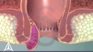 Thrombosed External Hemorrhoid  3D Medical Animation [upl. by Elleiad]