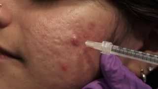 Watch amp Learn Intralesional injections [upl. by Leahcimnaj]