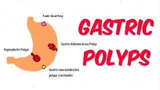 Gastric Stomach Polyps [upl. by Niuq]