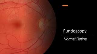 Healthy Retina Fundoscopy [upl. by Airretal]