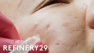 I Got Fillers For My Acne Scars  Macro Beauty  Refinery29 [upl. by Niarbo]