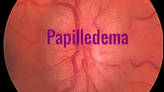 Papilledema A Swollen optic disc [upl. by Colette]