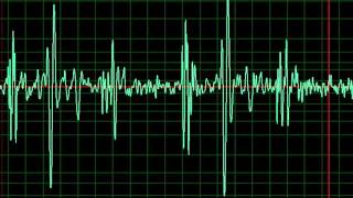 Congestive Heart Failure slow [upl. by Illil397]