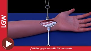 Wrist Fixator Surgery 3D Animation [upl. by Bev650]