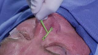 Demonstration of the Latera Implant for Nasal Valve Collapse Warning Graphic Surgical Content [upl. by Faythe]