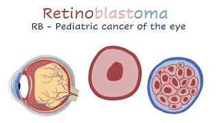 Retinoblastoma [upl. by Eenoj]