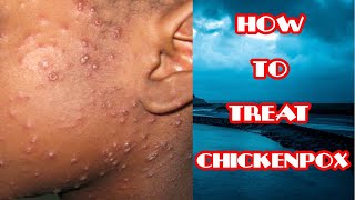 Chickenpox Treatment  How To Treat Chickenpox  Lifestyle amp Home Remedies [upl. by Arelc393]