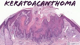 Keratoacanthoma 5Minute Pathology Pearls [upl. by Nelleyram422]