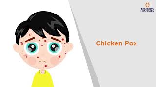 Chicken Pox Symptoms Causes Prevention and Treatment  Yashoda Hospitals [upl. by Zamora]