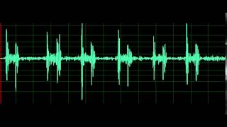 Pulmonary Associated Heart Sounds Tricuspid Regurgitation [upl. by Uokes]